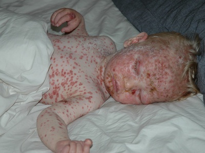 Chickenpox