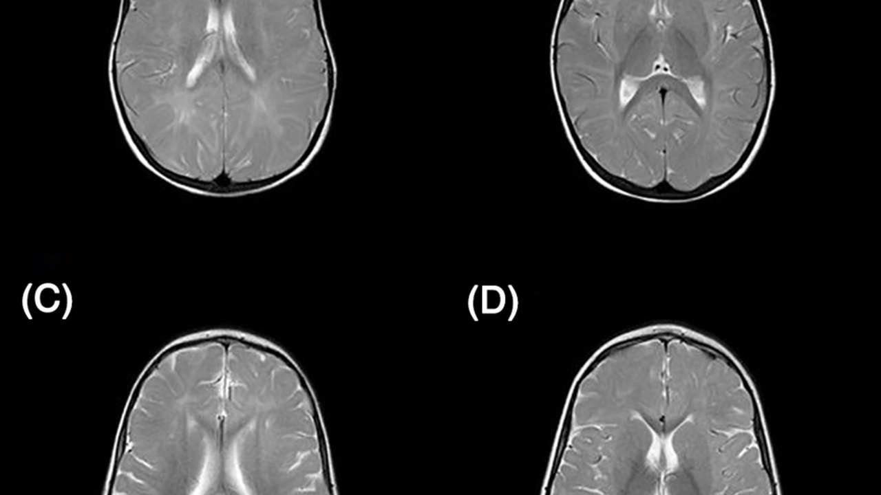 MRI scan showing hippocampal region and age-related volume change