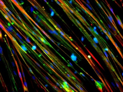 Duchenne muscular dystrophy