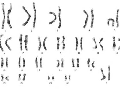 Klinefelter syndrome