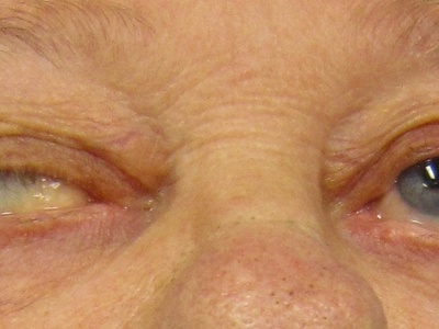 Myasthenia gravis