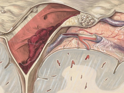 Posterior cerebral artery (PCA)