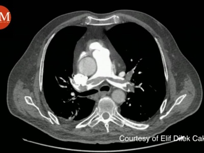 Pulmonary artery (main)