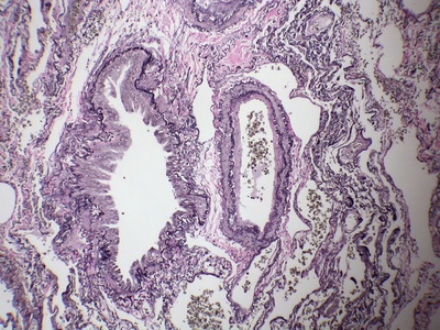 Right pulmonary artery