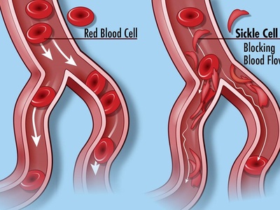 Sickle cell disease
